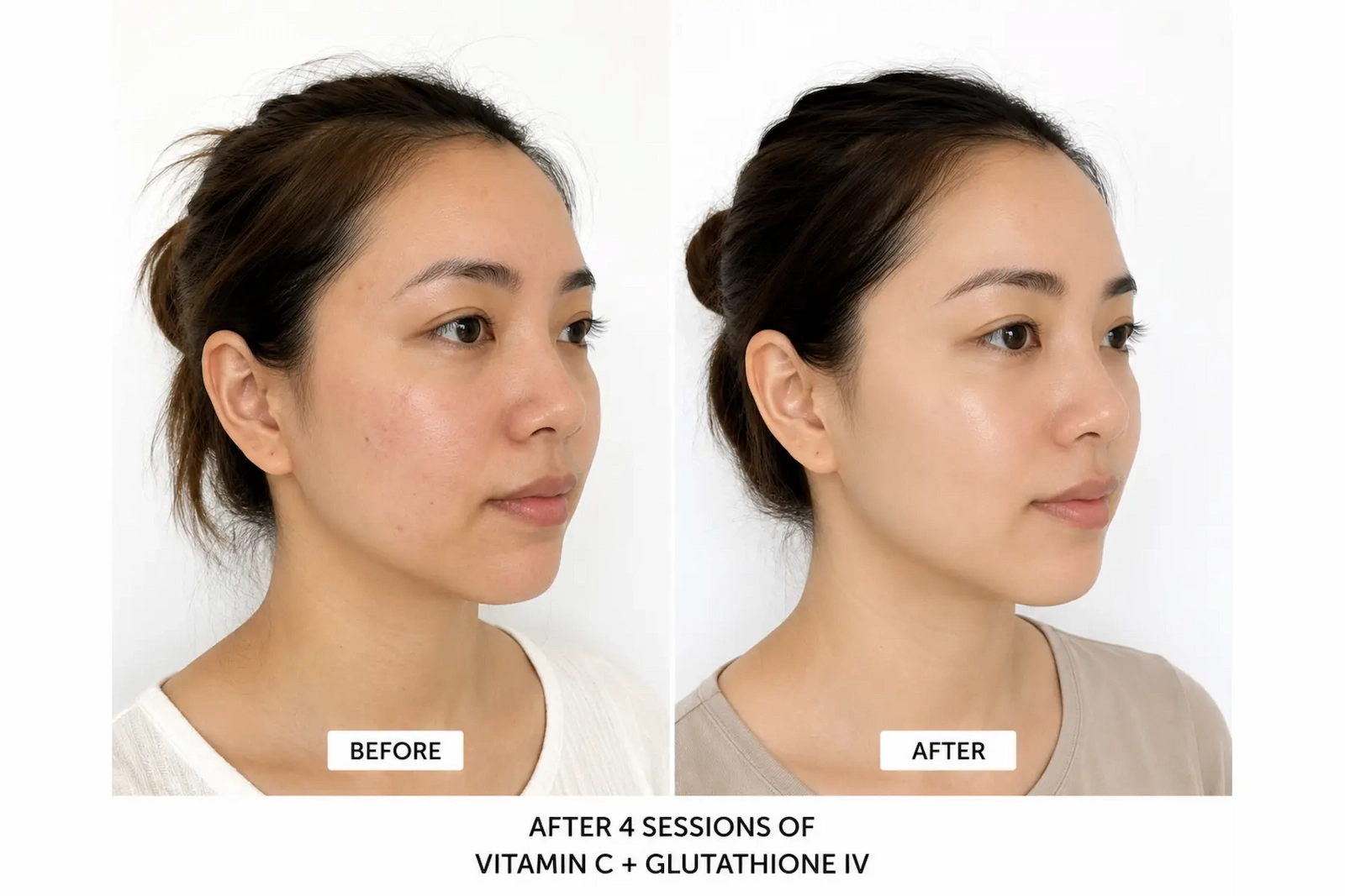 Before and after 4 sessions of Vitamin C and Glutathione IV wellness therapy